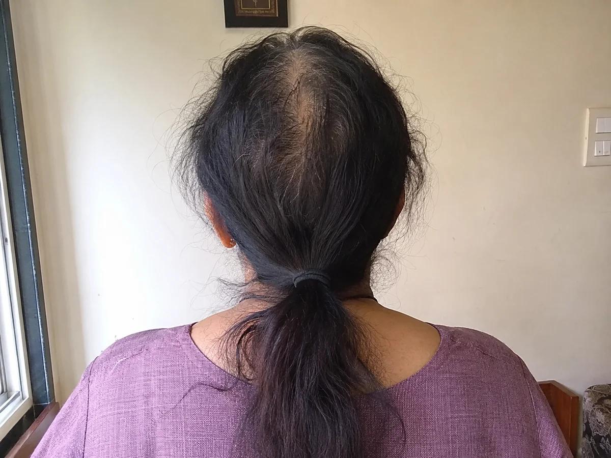 Hair before starting the herbal hair oil — thinning with a wide parting